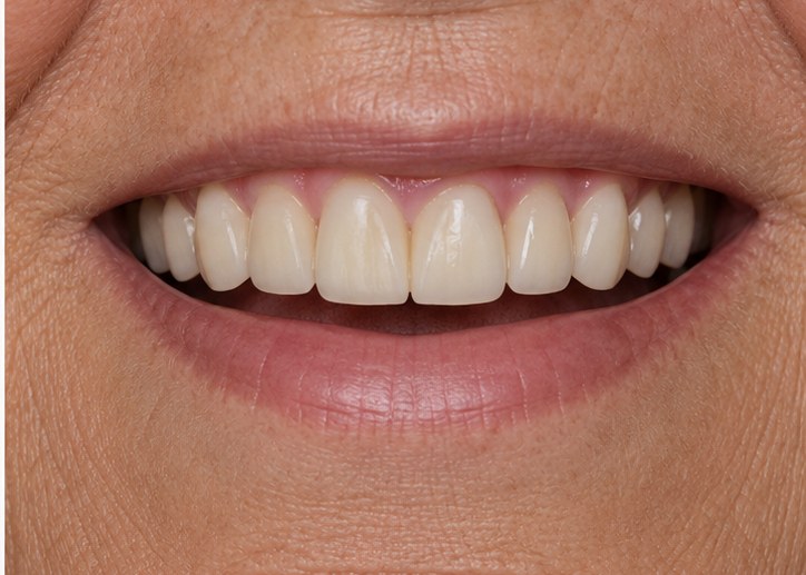 Multiple-Tooth Restoration — after