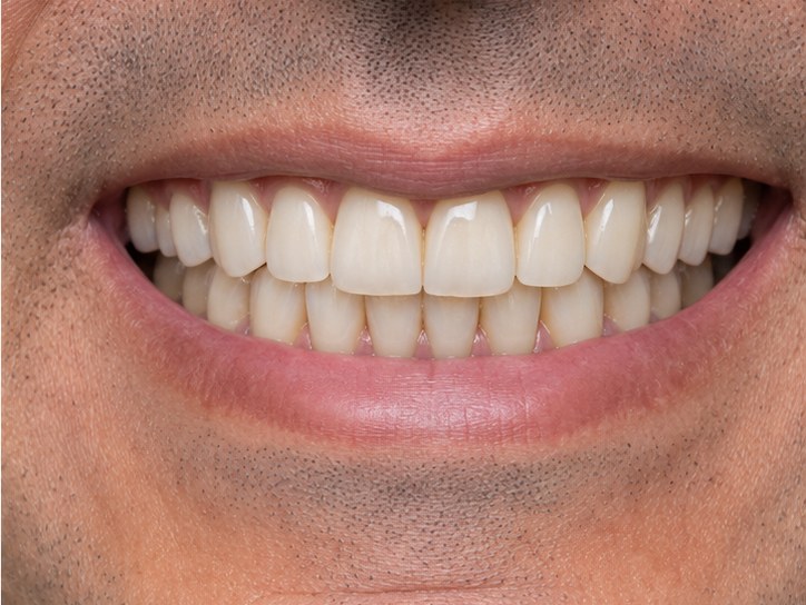 Full-Arch Smile Restoration — after