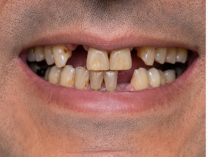 Full-Arch Smile Restoration — before